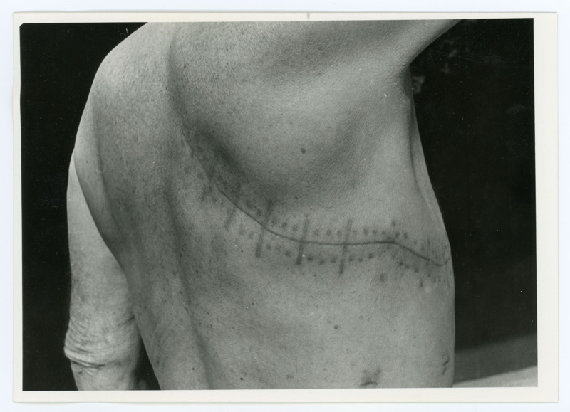 Black and white photograph of Donald Crabtree's surgical scars. This scar goes from the middle of his back and around his right side. Crabtree is holding his right arm up to show how far the scar reaches.