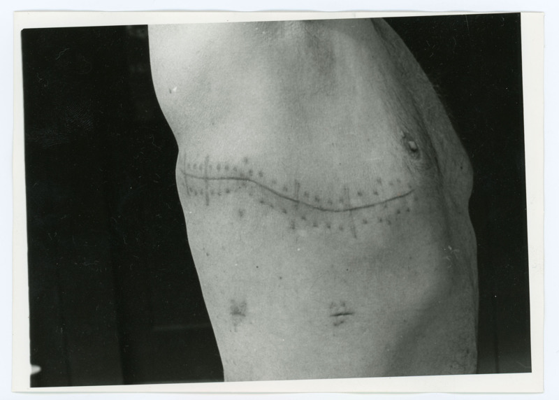 Black and white photograph of Donald Crabtree's surgical scars. The scar wraps around his upper right side, stopping just under the nipple. He is holding up his arm to show how far the scar wraps around.