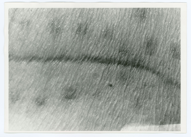 Black and white photograph of Donald Crabtree's surgical scars.