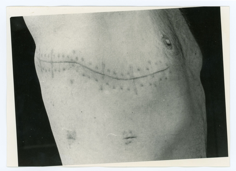 Black and white photograph of Donald Crabtree's surgical scars. The scar wraps around his upper right side, stopping just under the nipple. He is holding up his arm to show how far the scar wraps around.