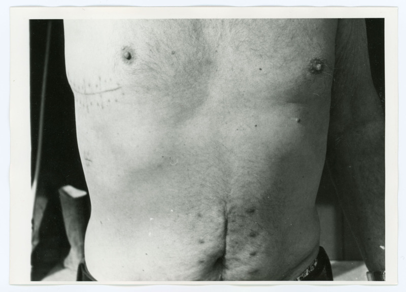 Black and white photograph of Donald Crabtree's surgical scars. The scar is on his upper right abdomen (viewer's left) and it starts around his side. The scar ends just below the nipple.