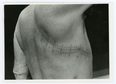Surgical Scar Photograph