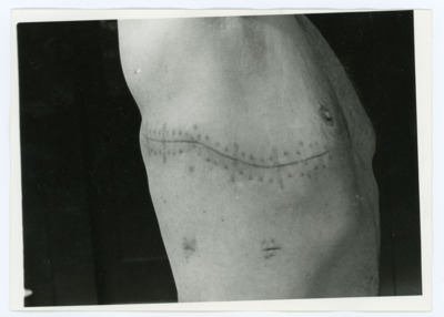 Surgical Scar Photograph