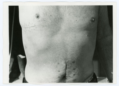 Surgical Scar Photograph